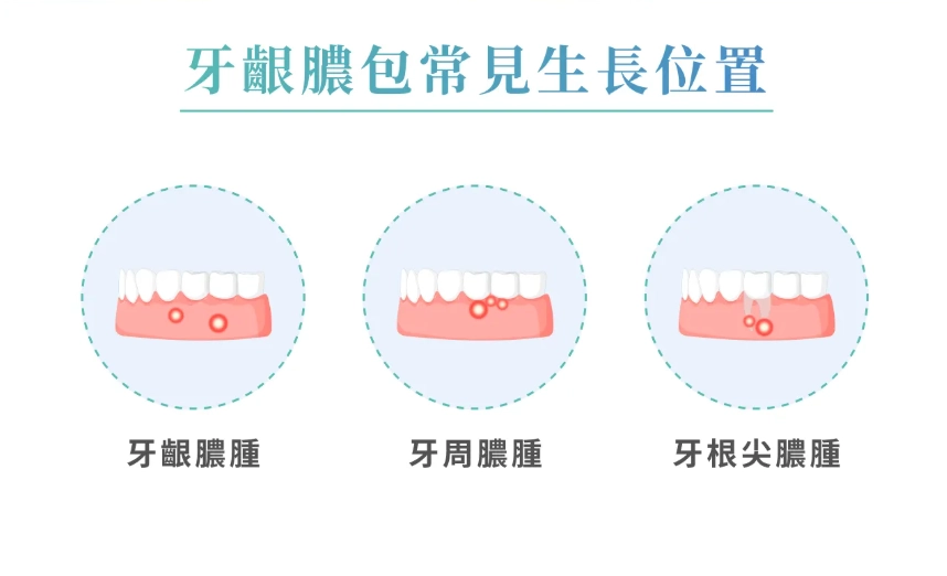 智齒冠周炎