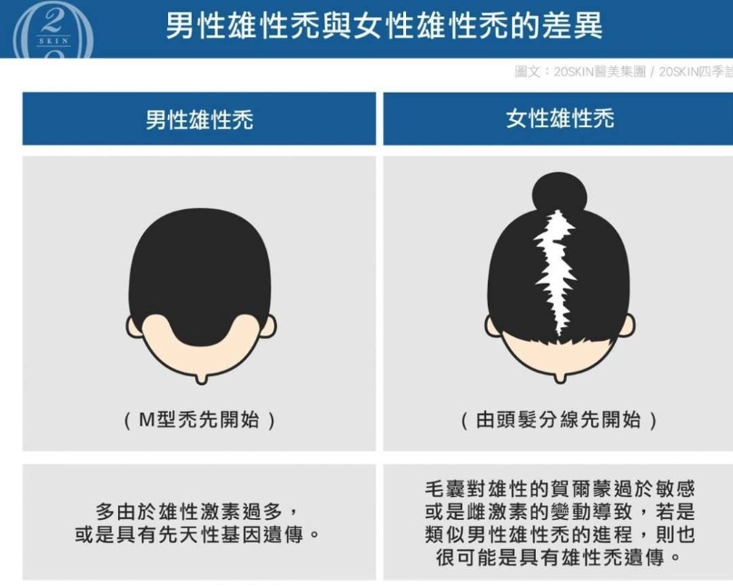 雄性禿治療
