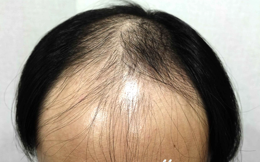 雄性禿治療