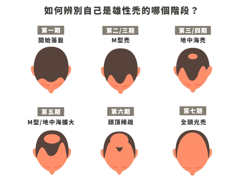 雄性禿治療