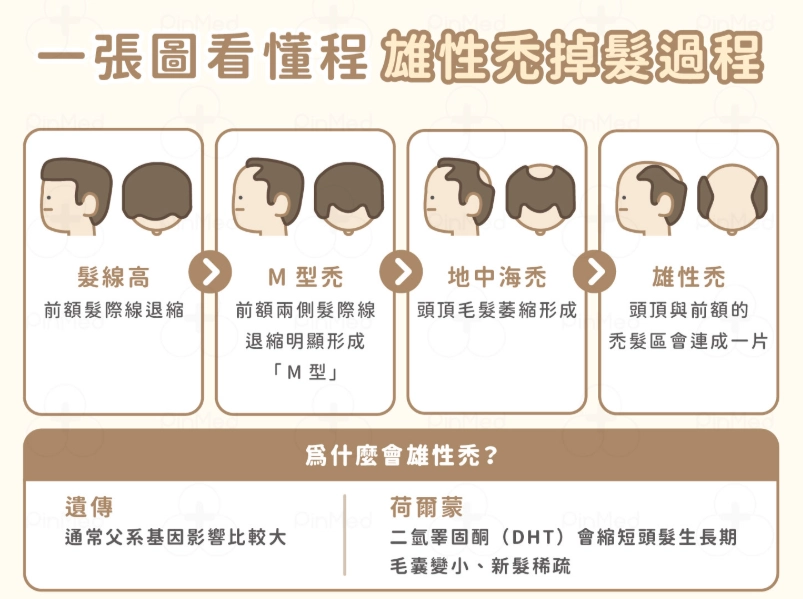 雄性禿初期