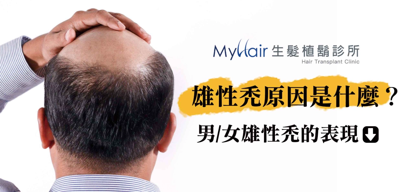 雄性禿初期