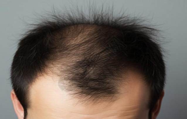 男性頭頂稀疏 男性頭頂稀疏