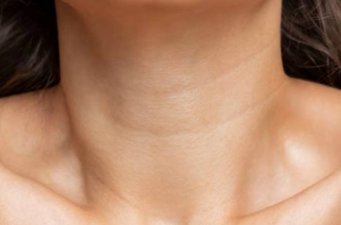 頸紋消除 頸紋消除