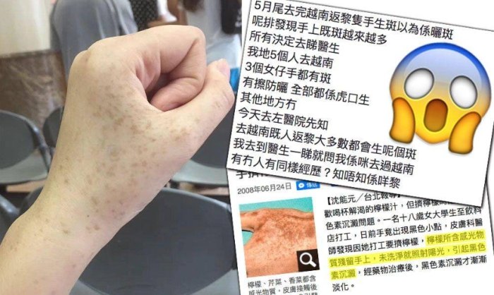 虎口色素沉着治療