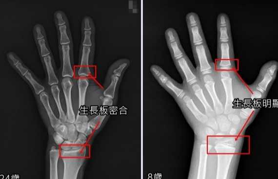 生長板閉合後長高方法