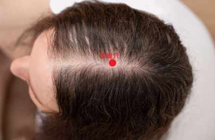 頭頂穴道痛治療