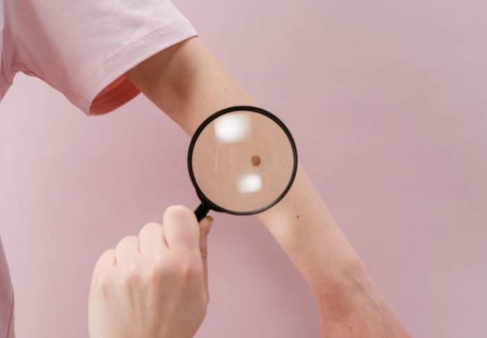 手臂黑斑治療 手臂黑斑治療