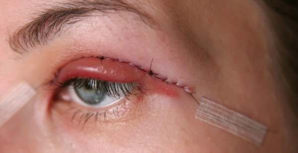 雙眼皮手術恢復