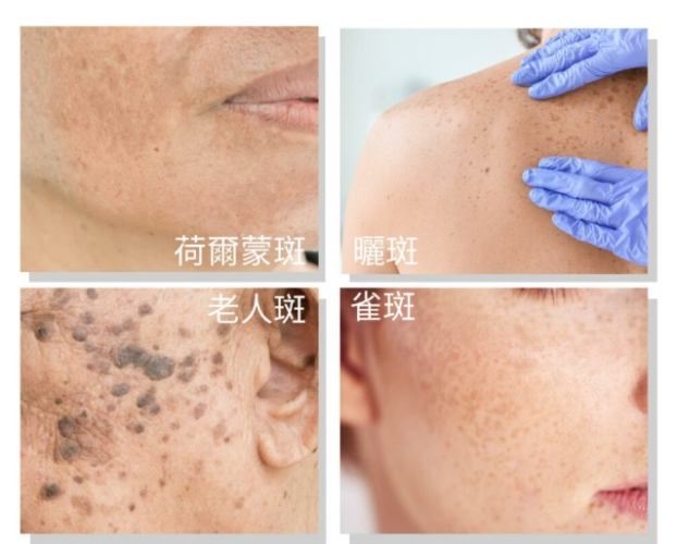 斑點治療