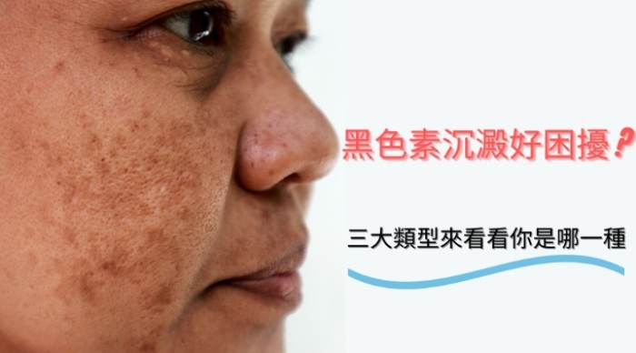 黑斑淡化技巧 黑斑淡化技巧