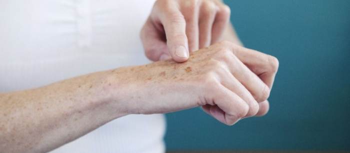 皮膚黑斑診斷 皮膚黑斑診斷