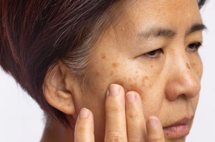 退黑斑方法 退黑斑方法