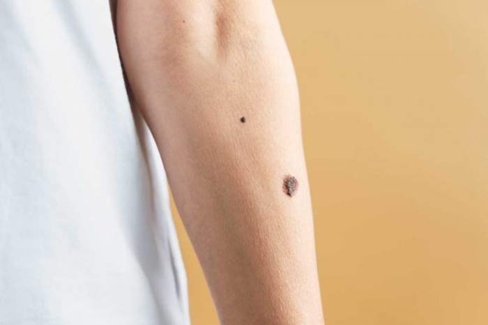 手臂黑斑治療 手臂黑斑治療