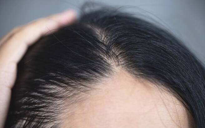 頭頂頭髮稀疏