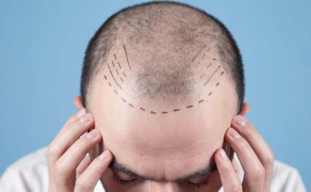 頭頂頭髮稀疏