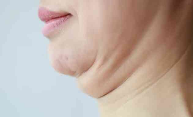 下顎線模糊成因