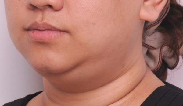 下顎線模糊成因