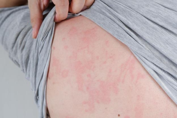 蕁麻疹症狀原因