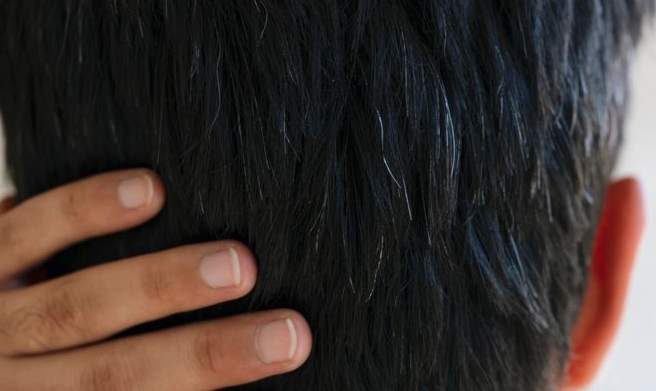 早生白髮治療 早生白髮治療