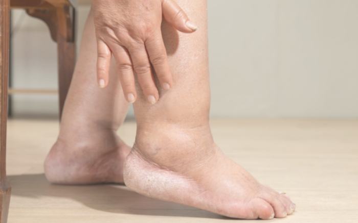 喝酒腳水腫治療 喝酒腳水腫治療