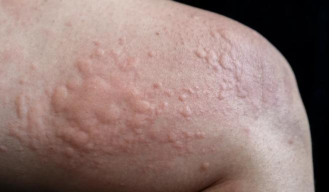 戒菸副作用 戒菸副作用