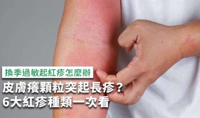 丘疹性蕁麻疹圖片 丘疹性蕁麻疹圖片