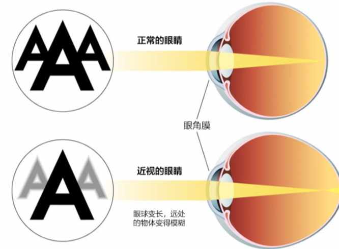 眼睛焦距訓練 眼睛焦距訓練