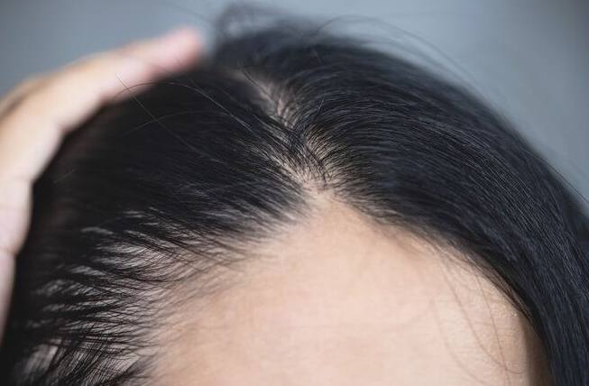 女性掉髮原因 女性掉髮原因