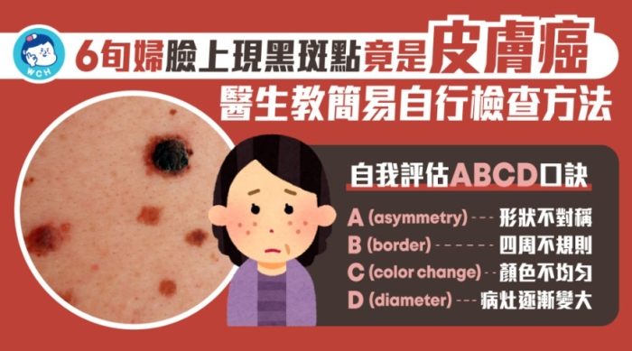 黑斑成因 黑斑成因