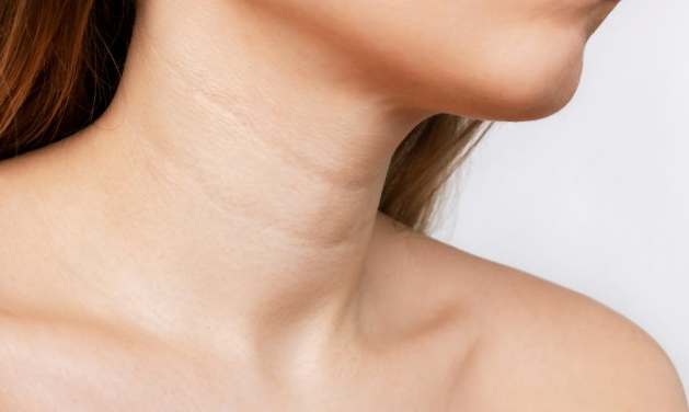 頸紋消除 頸紋消除