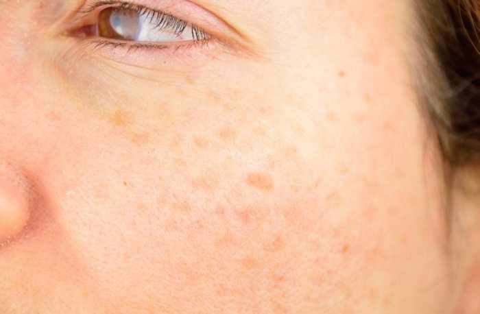 黑斑治療 黑斑治療