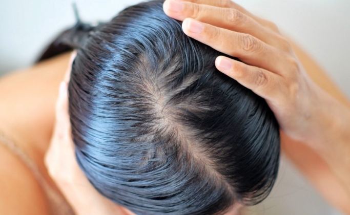 女性頭頂稀疏原因