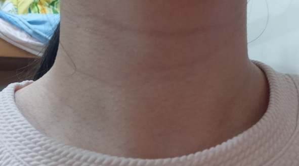 頸紋消除 頸紋消除