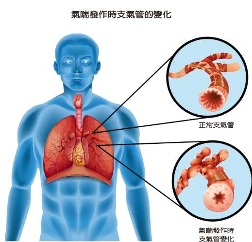 氣管收縮症狀 氣管收縮症狀