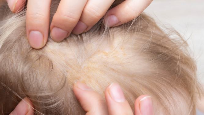 頭皮脂漏性皮膚炎多久會好