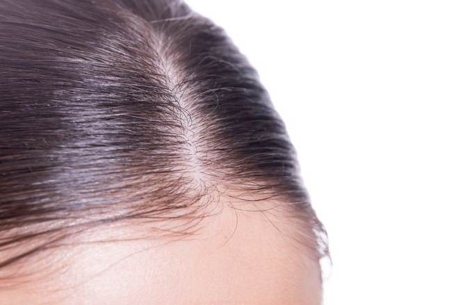 頭髮稀疏改善 頭髮稀疏改善