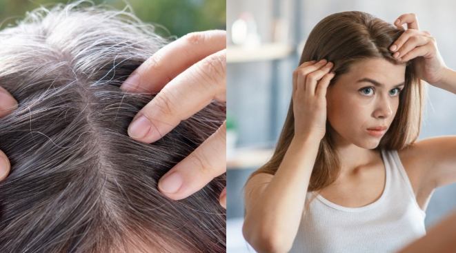 早生白髮治療 早生白髮治療