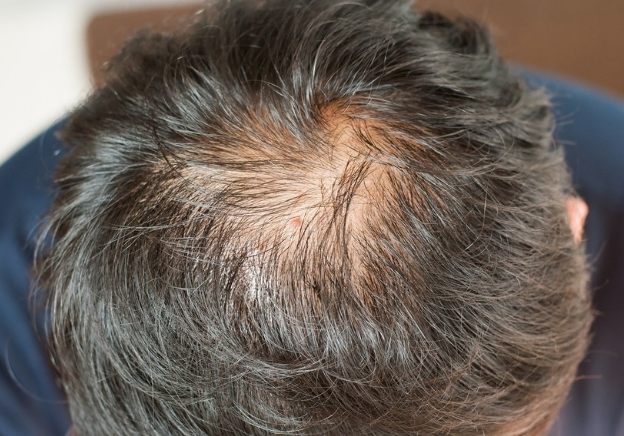 男性頭頂稀疏 男性頭頂稀疏