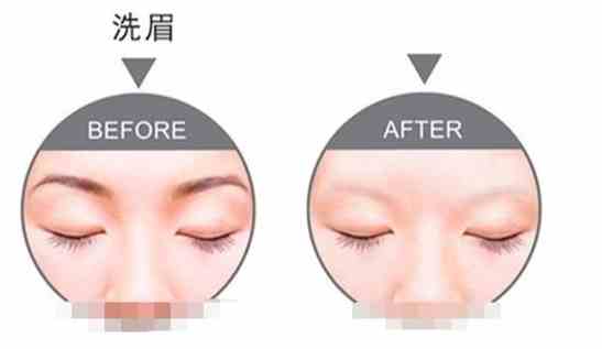 雷射洗眉 雷射洗眉