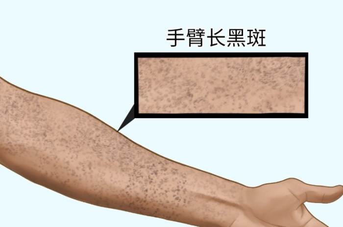 手臂突然出現黑斑