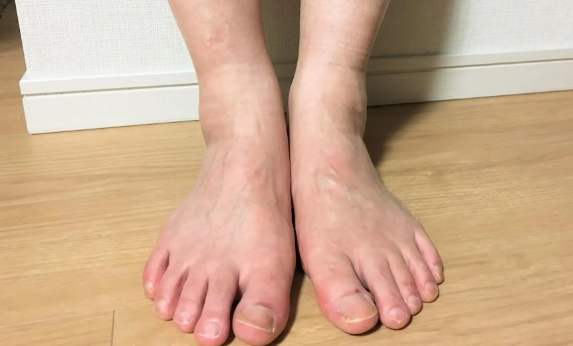 喝酒腳水腫原因 喝酒腳水腫原因