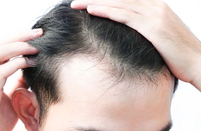 男性頭頂稀疏 男性頭頂稀疏
