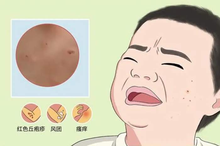 丘疹性蕁麻疹治療 丘疹性蕁麻疹治療