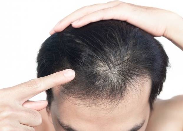 男士脫髮食物