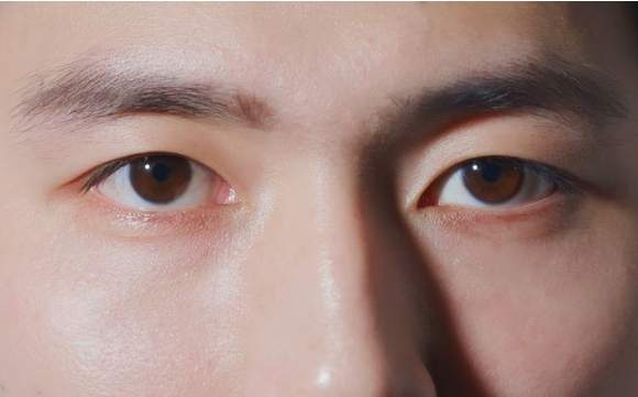 天生大小眼原因