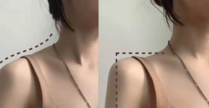 斜方肌厚改善 斜方肌厚改善