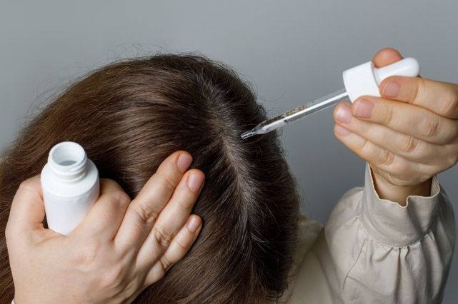 掉髮治療方法 掉髮治療方法