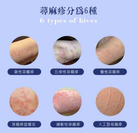 丘疹性蕁麻疹圖片 丘疹性蕁麻疹圖片