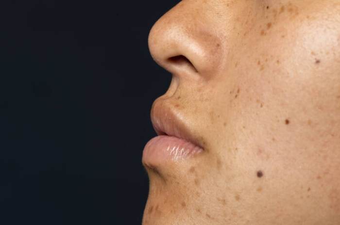 黑斑成因 黑斑成因